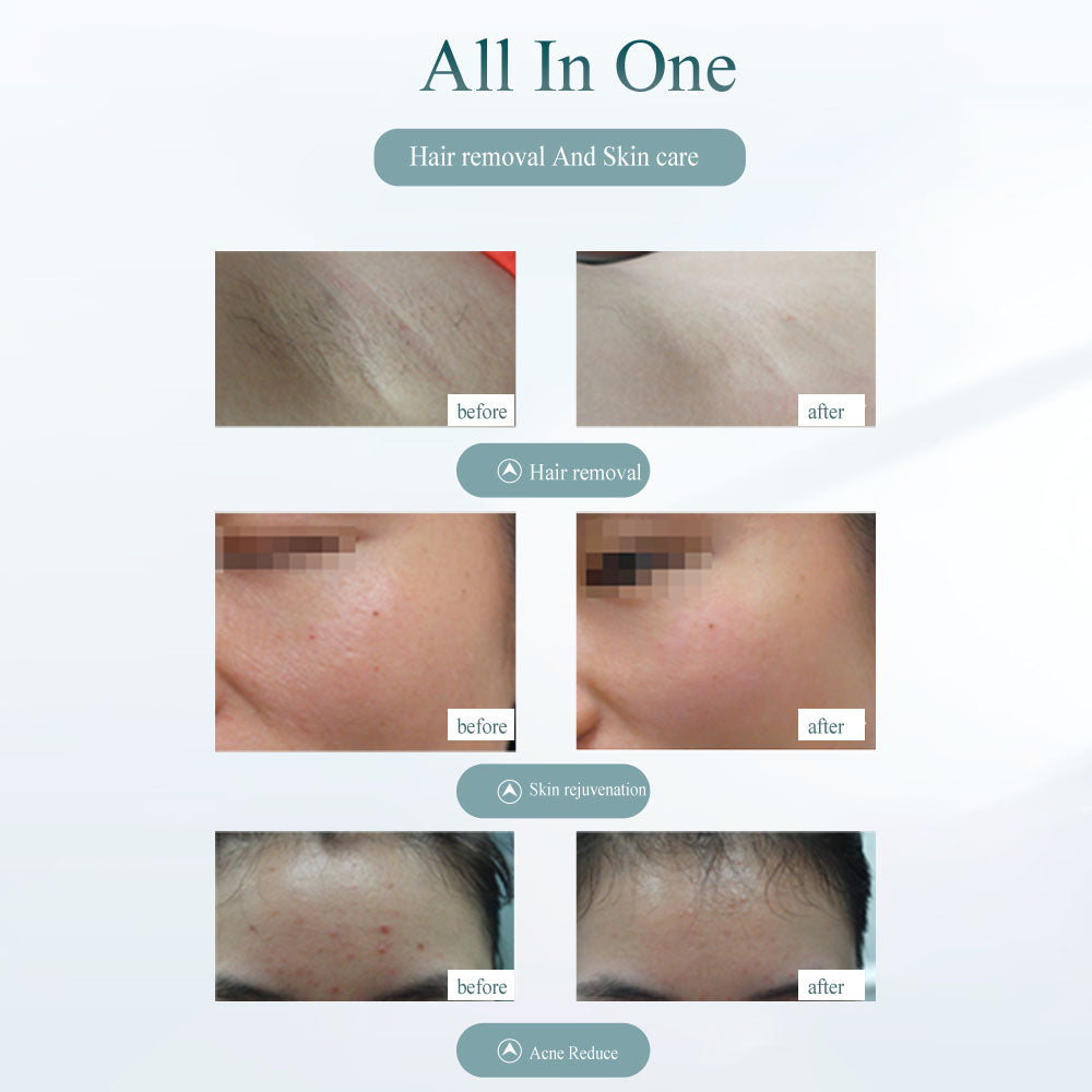 Laser Hair Removal Device  Achieve smooth, hair-free skin from the comfort of your home. This advanced laser hair removal device helps reduce unwanted hair, leaving your skin feeling soft, silky, and beautifully smooth with every treatment.